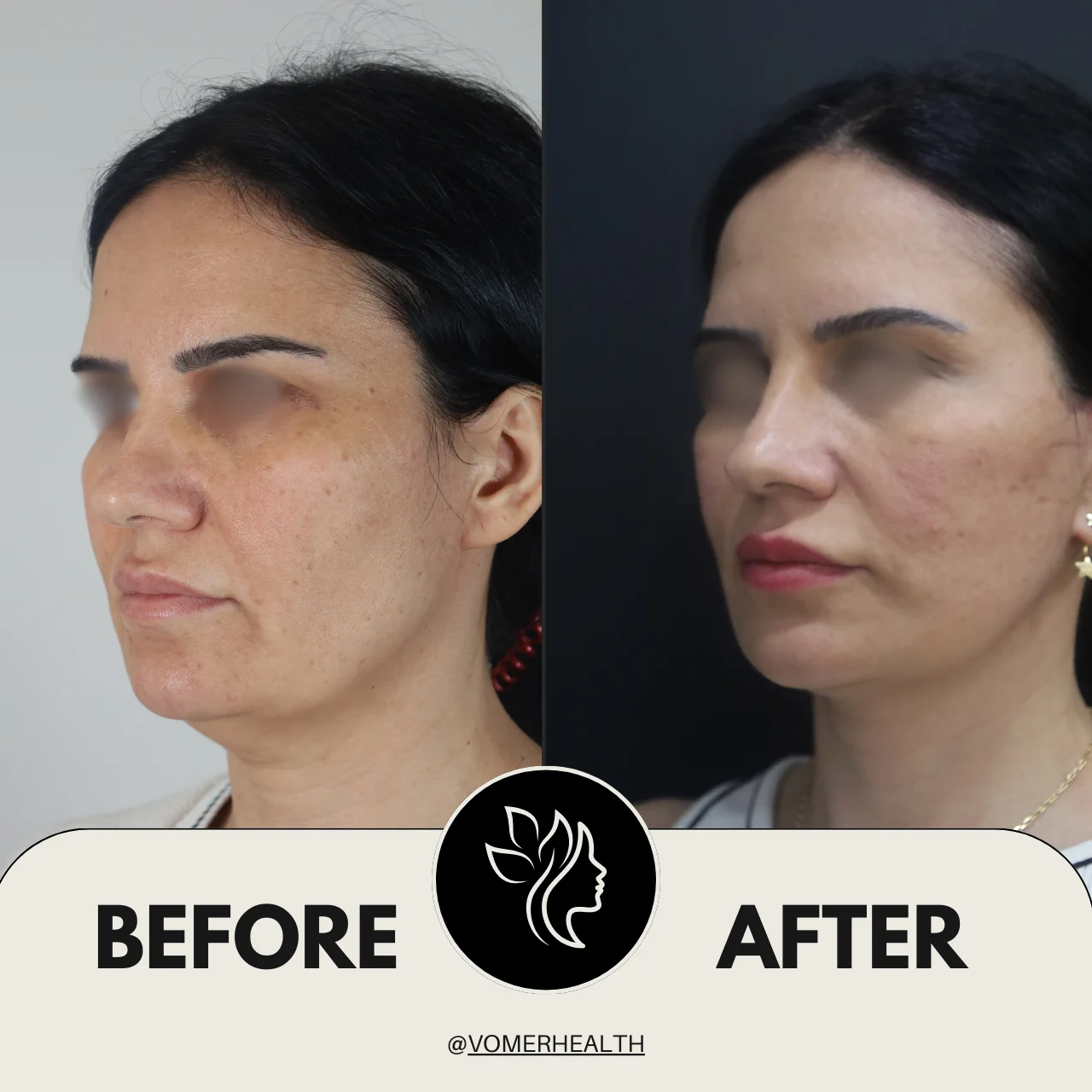 Bulldog Estetiği Önce Sonra 8