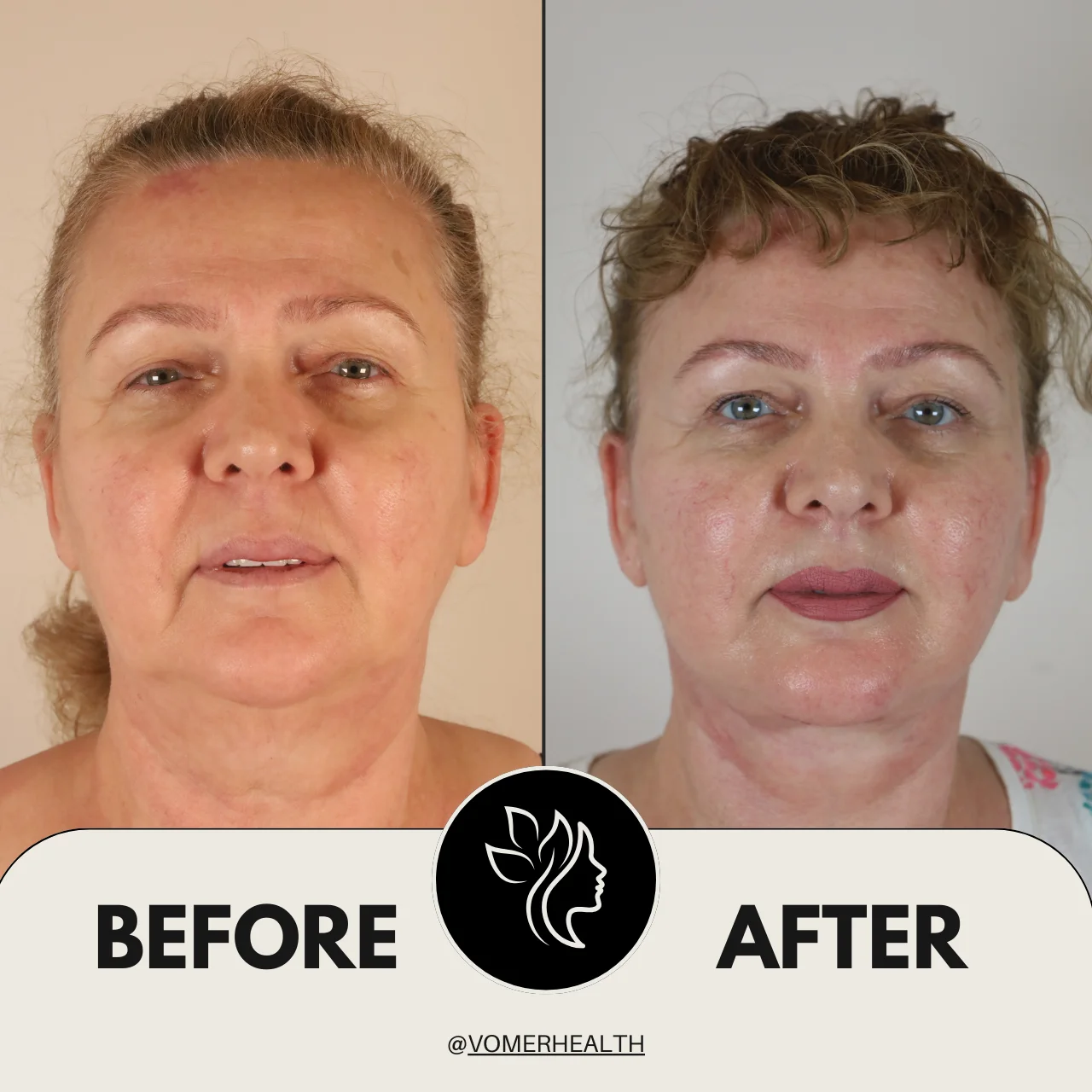 Bulldog Estetiği Önce Sonra 7