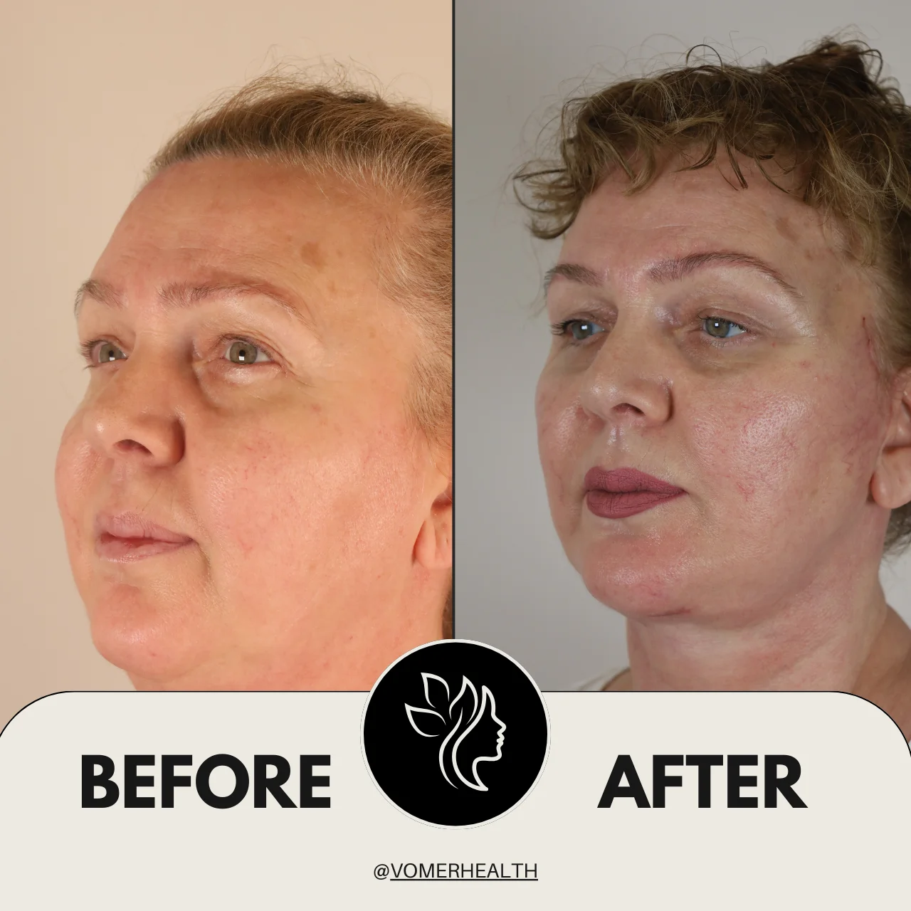 Bulldog Estetiği Önce Sonra 6