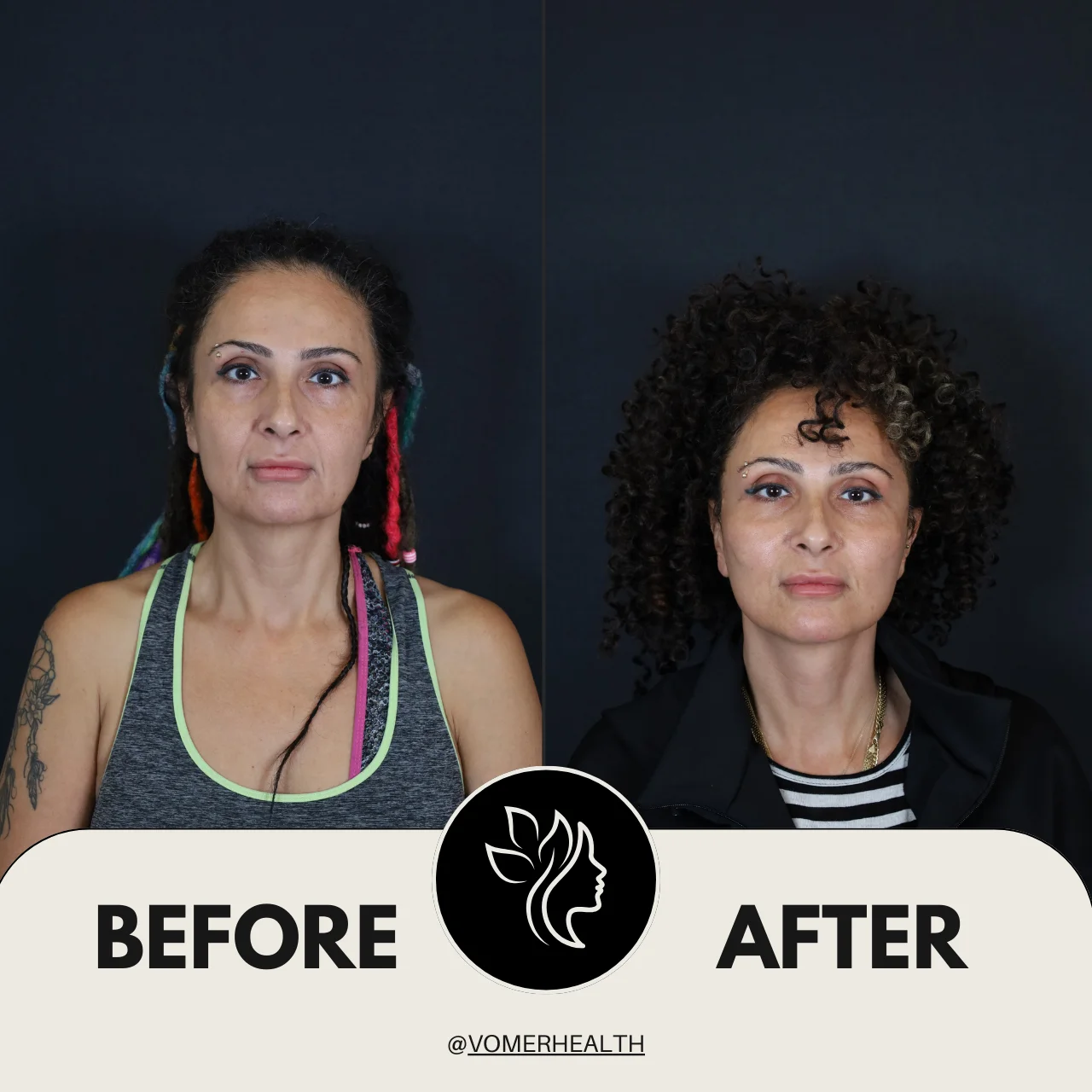 Bulldog Estetiği Önce Sonra 5