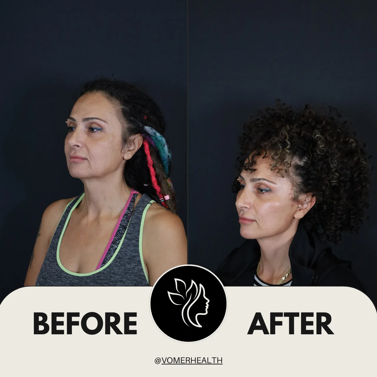 Bulldog Estetiği Önce Sonra 4