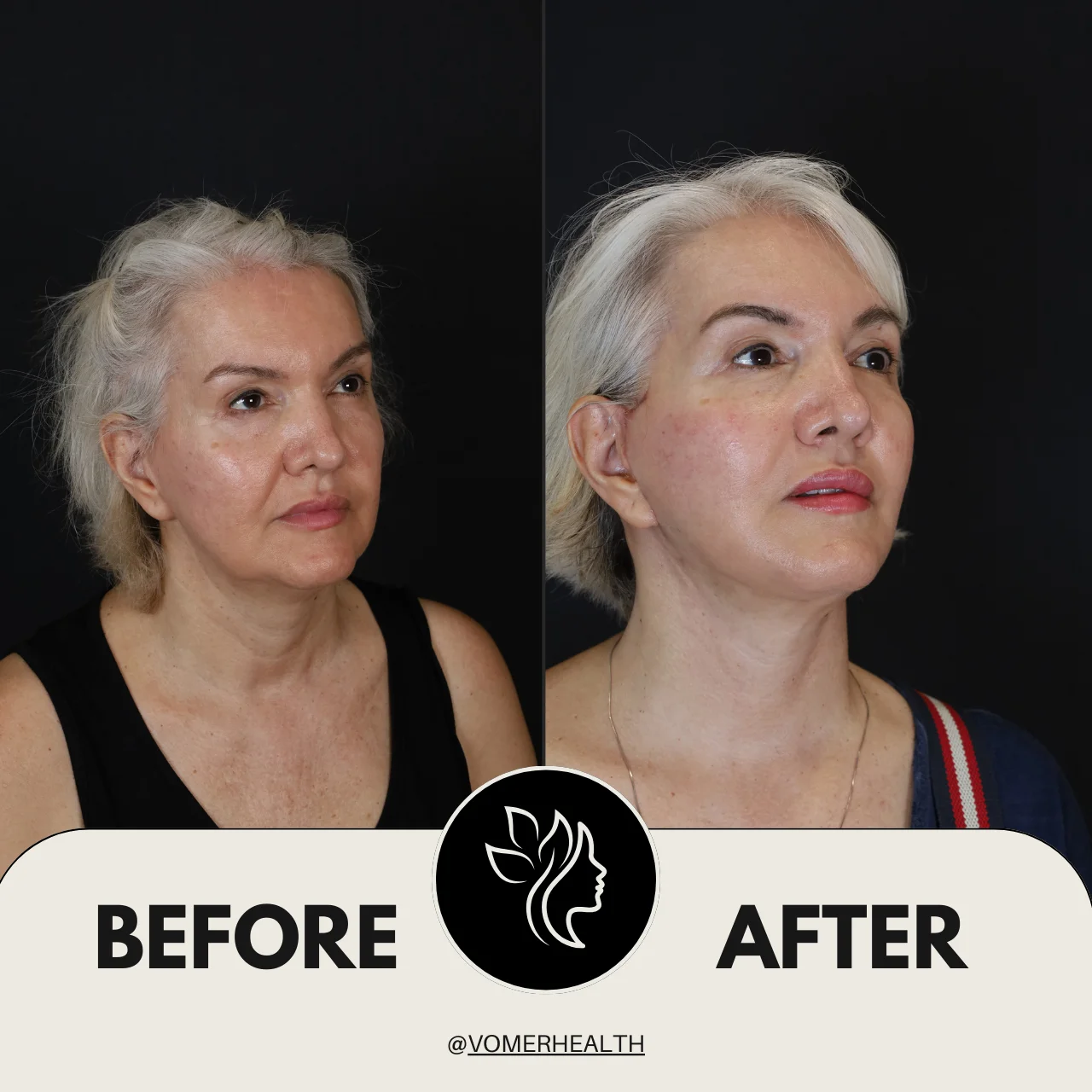 Bulldog Estetiği Önce Sonra 3