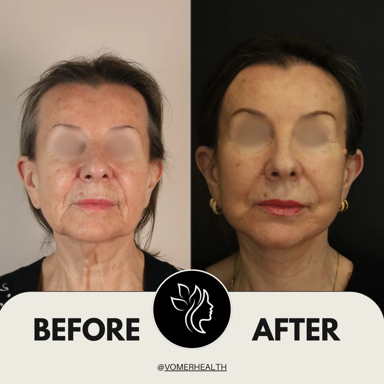 Bulldog Estetiği Önce Sonra 2