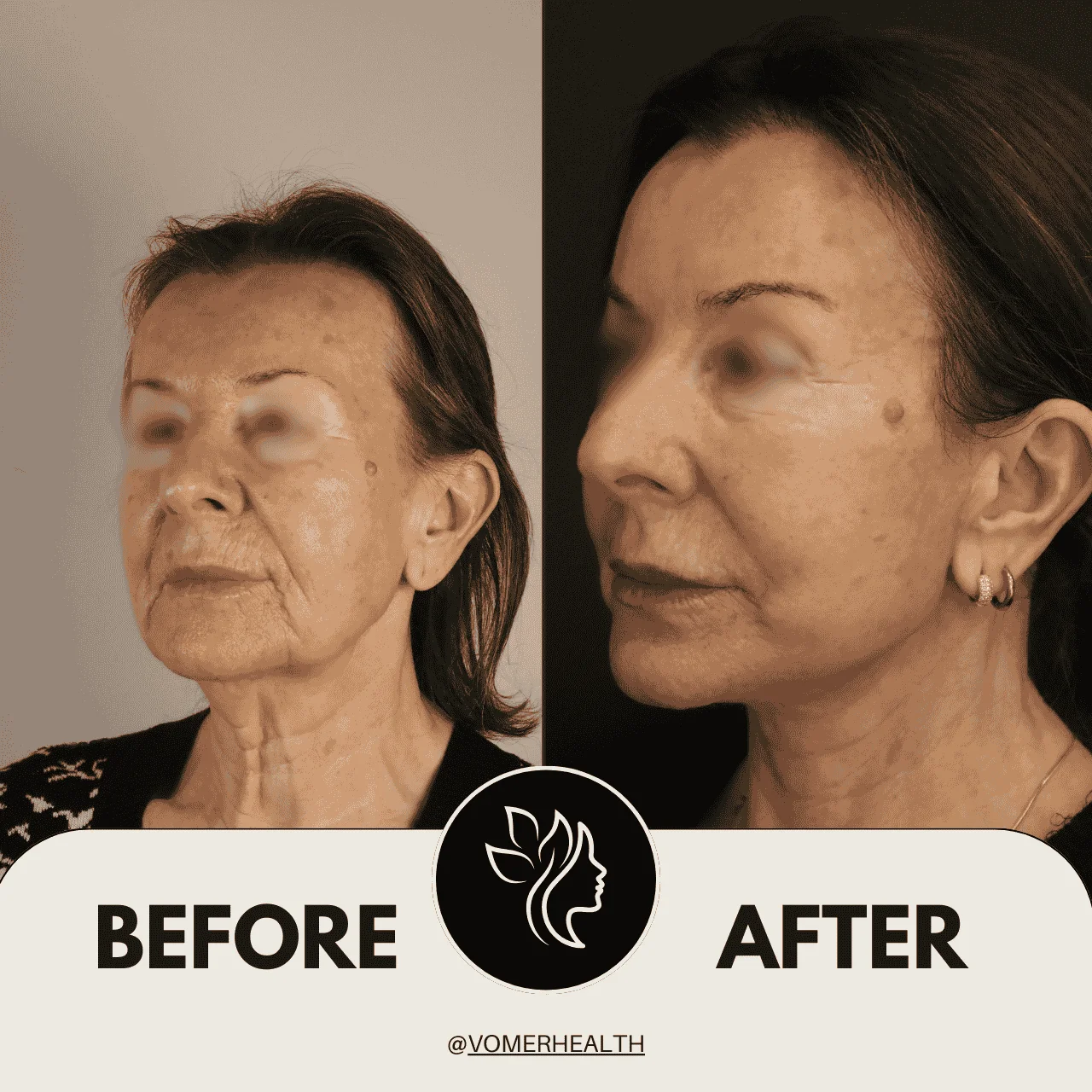 Bulldog Estetiği Önce Sonra 1