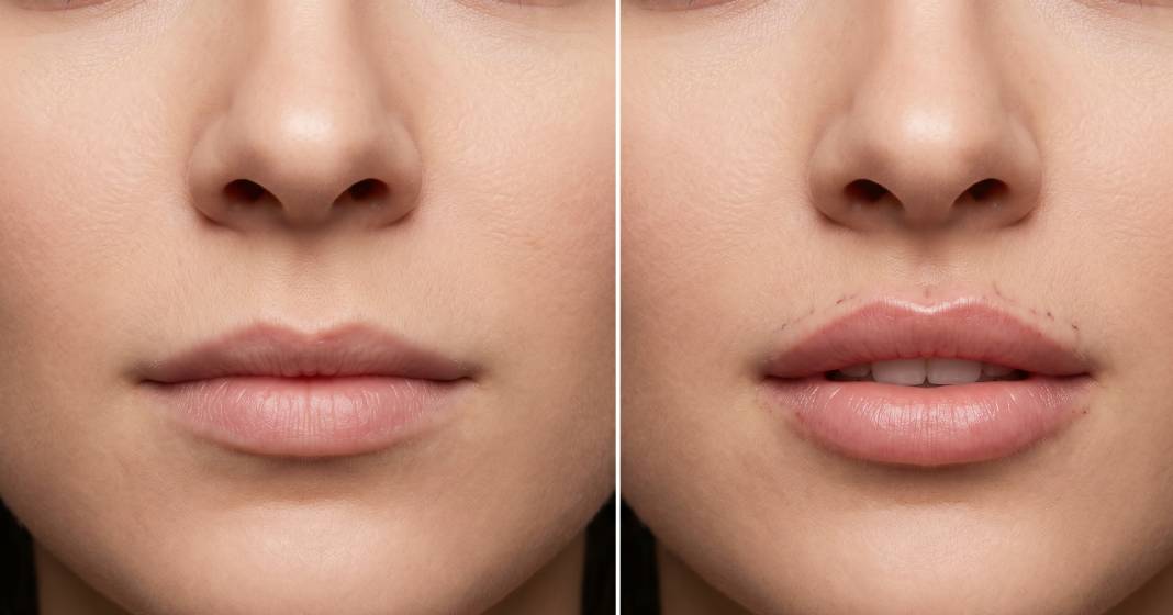 lazer destekli dudak kaldirma