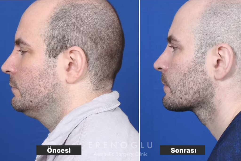 Boyun Germe Ameliyatı öncesi sonrası