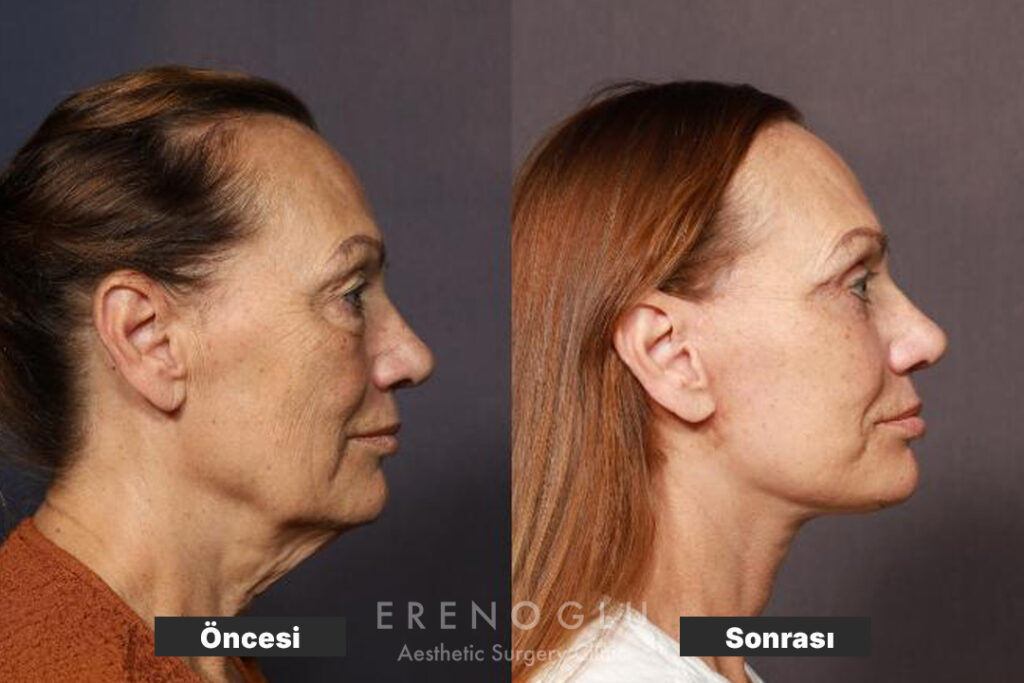 Boyun Germe Ameliyatı öncesi sonrası