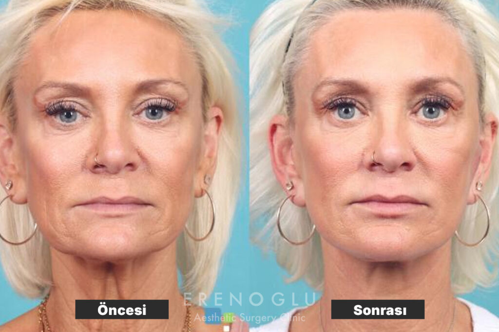 Boyun Germe Ameliyatı öncesi sonrası