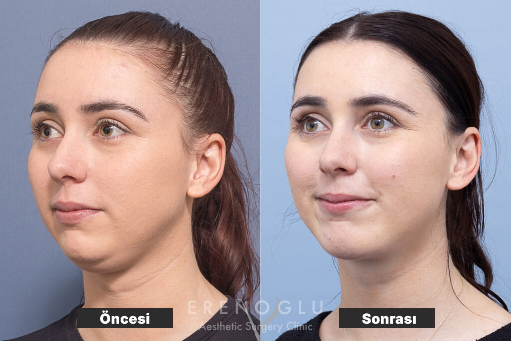 Boyun Germe Ameliyatı öncesi sonrası