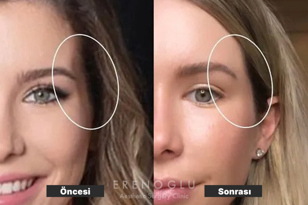 Şakak Dolgusu Öncesi Sonrası Değişimler (Before & After)