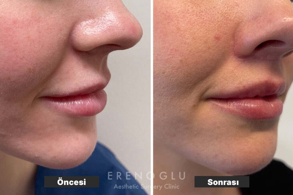 Lip Lift Öncesi Sonrası Değişimler