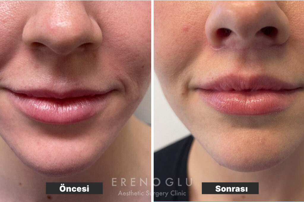 Lip Lift Öncesi Sonrası Değişimler