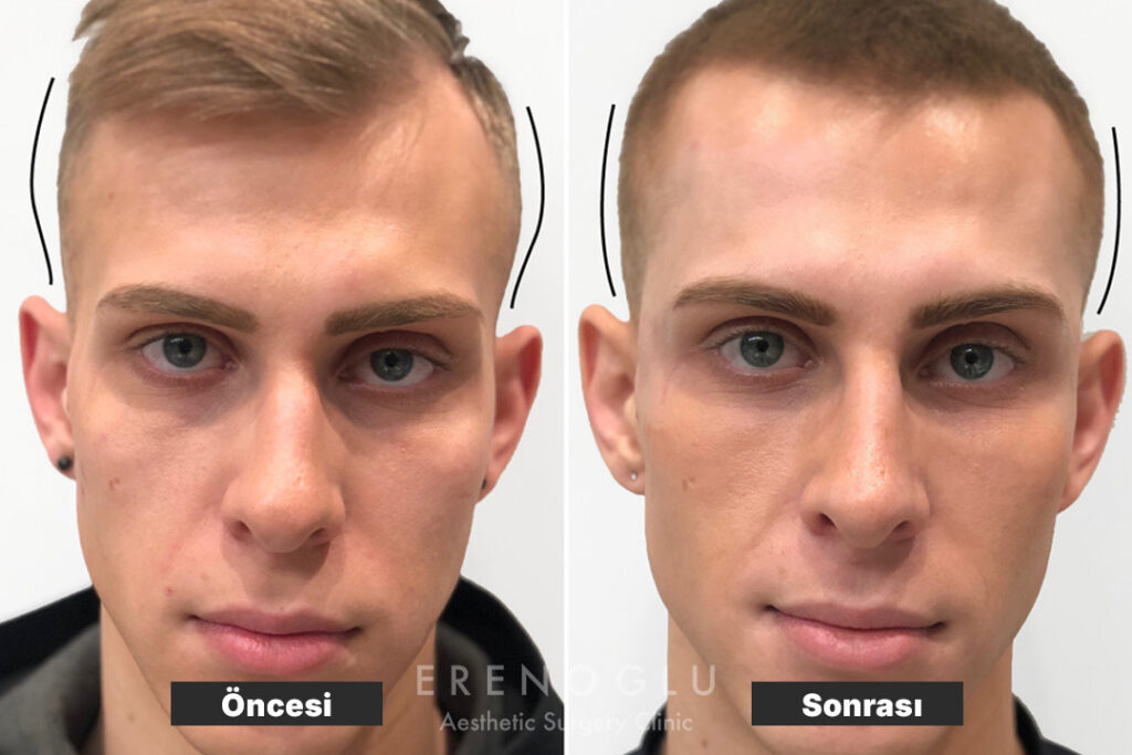 Şakak Dolgusu Öncesi Sonrası Değişimler (Before & After)