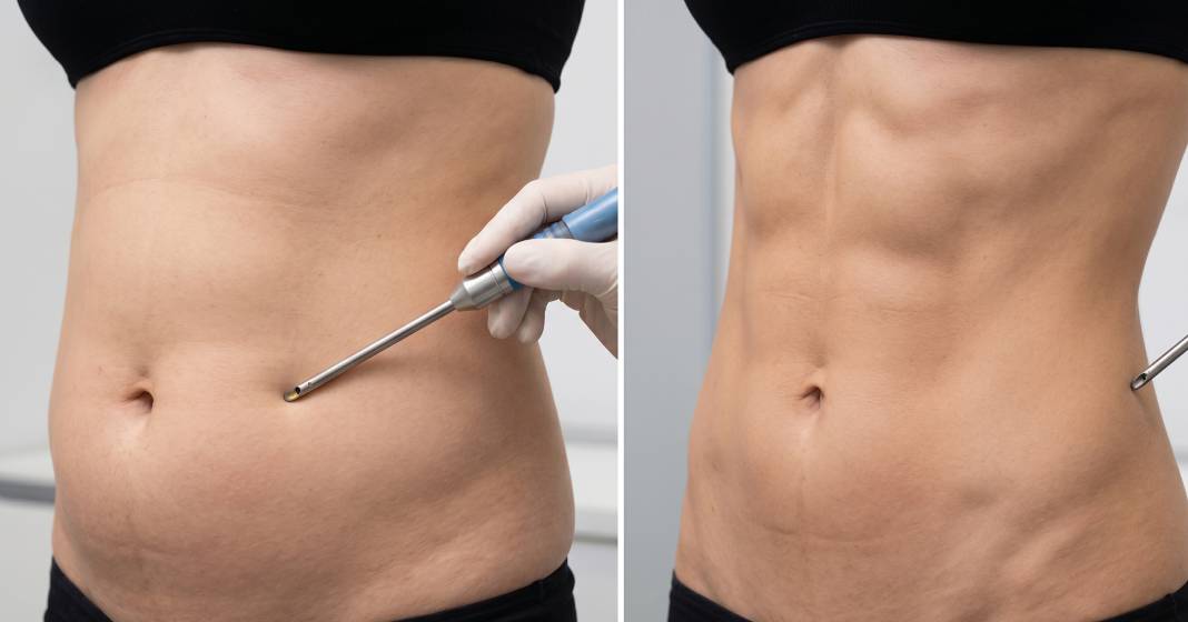 vaser liposuction
