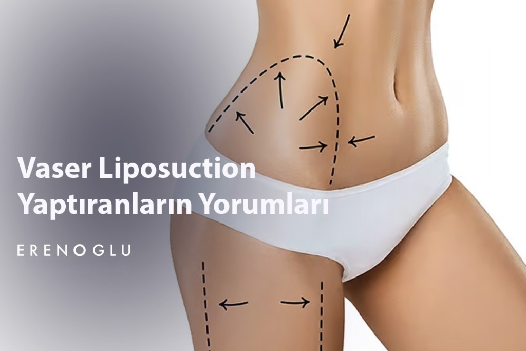 Vaser Liposuction Yaptiranlarin Yorumlari