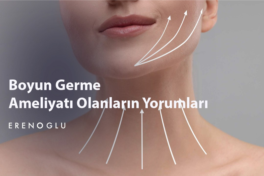 Boyun Germe Ameliyati Olanlarin Yorumlari