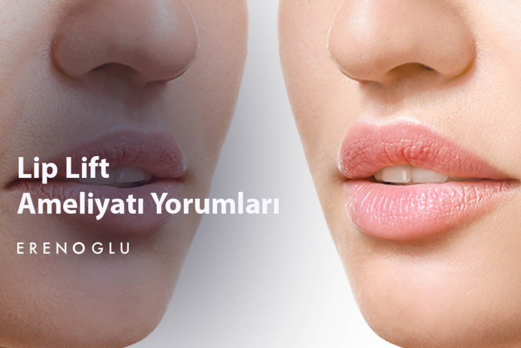 Lip Lift Ameliyati Yorumlari