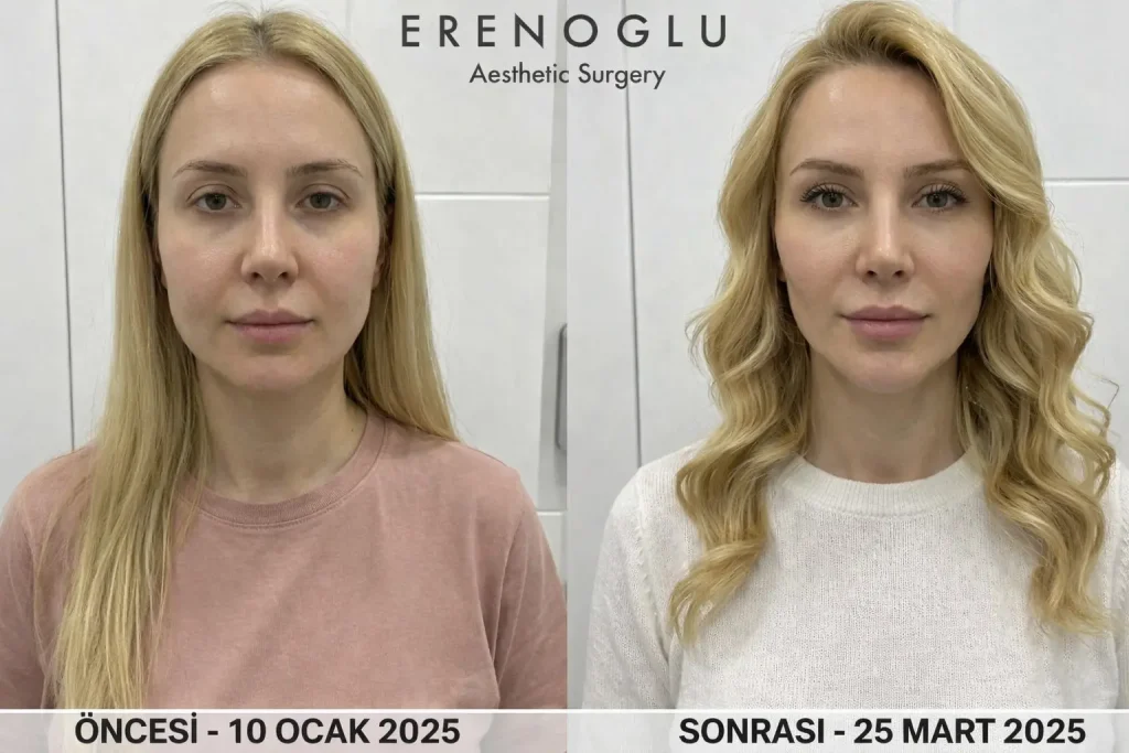 Hollywood Yanagi Oncesi Sonrasi