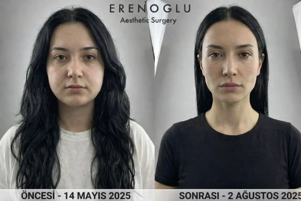 Hollywood Yanagi Oncesi Sonrasi foto