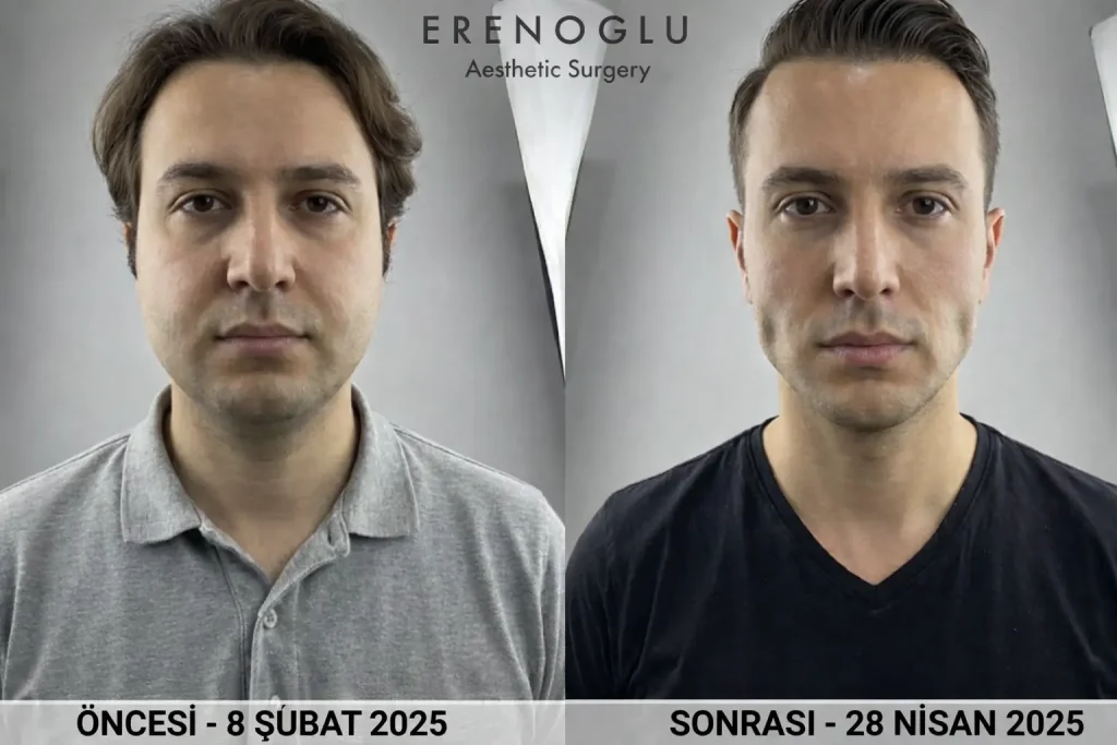 Hollywood Yanagi Oncesi Sonrasi fotograf