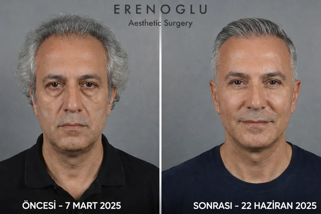 Orta Yuz Germe Oncesi Sonrasi Fotografla