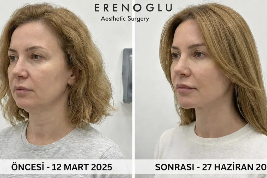 gıdı germe ameliyatı öncesi sonrası foto