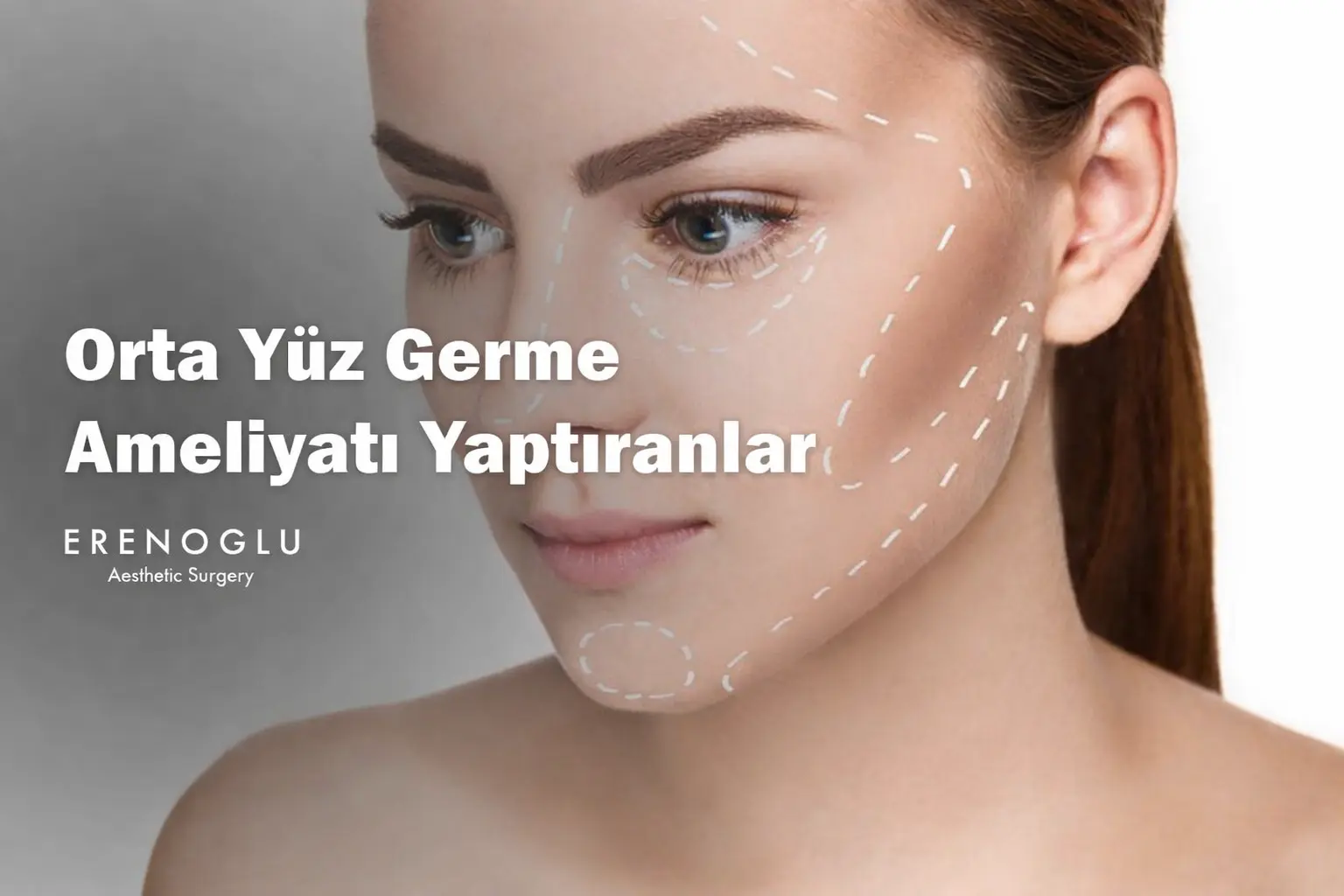 orta yüz germe ameliyatı yaptıranlar