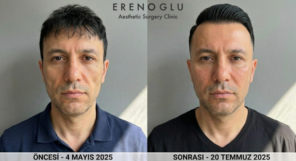 Yüze Yağ Enjeksiyonu Öncesi ve Sonrası Değişimler