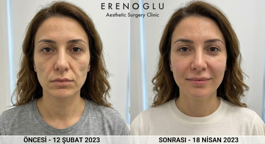 Yüze Yağ Enjeksiyonu Öncesi ve Sonrası Değişimler
