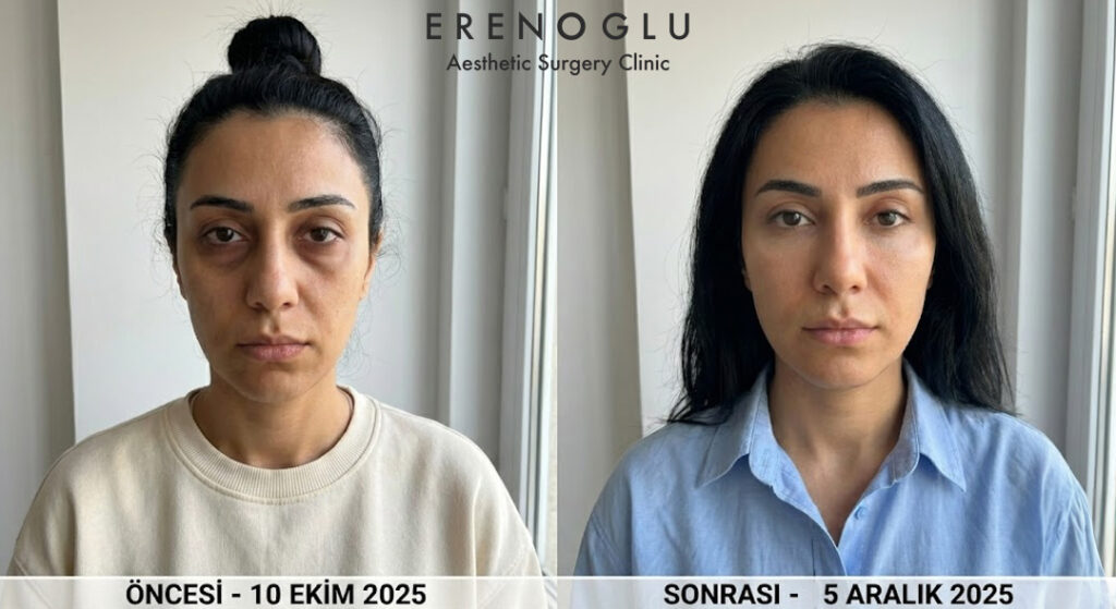 Yüze Yağ Enjeksiyonu Öncesi ve Sonrası Değişimler