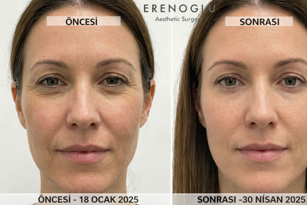 Kaz Ayağı Botoks Öncesi ve Sonrası