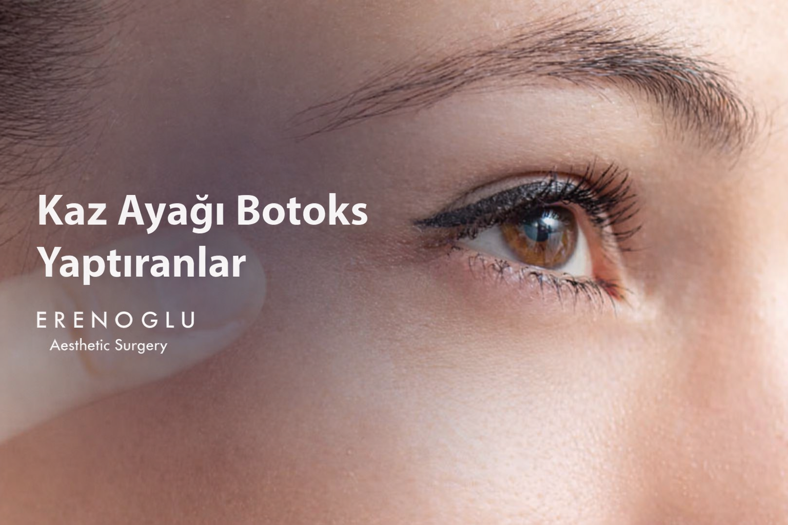 Kaz Ayağı Botoks Yaptıranlar