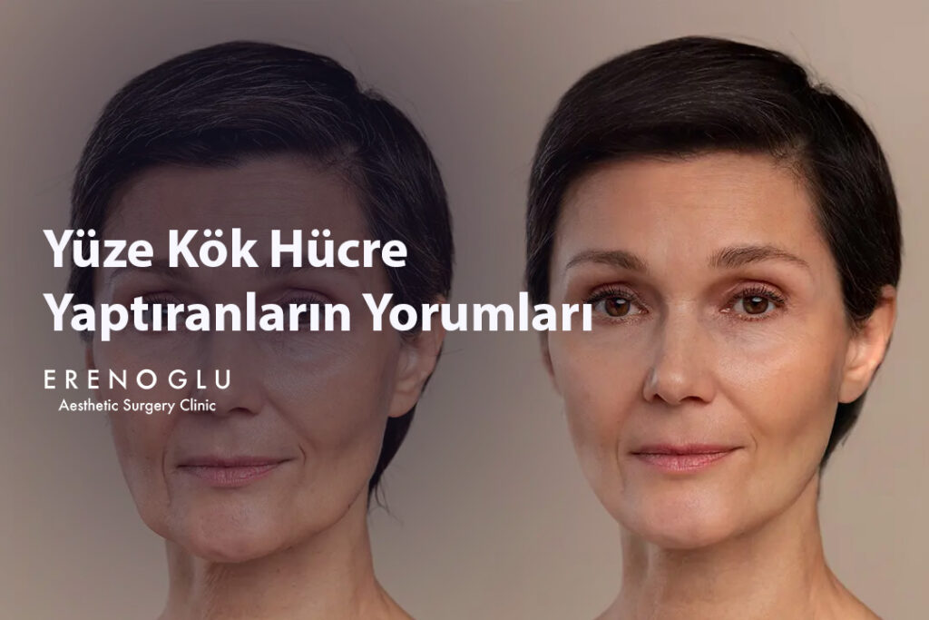 Yüze Kök Hücre Yaptıranların Yorumları