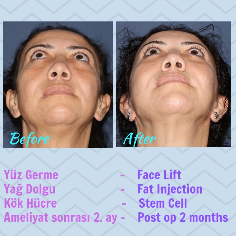 Yüz germe ameliyatı öncesi sonrası