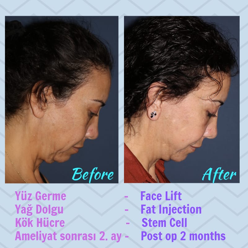 Yüz germe ameliyatı öncesi sonrası