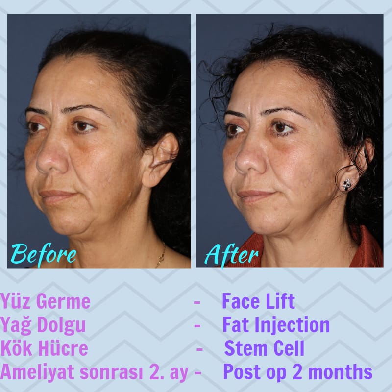 Yüz germe ameliyatı öncesi sonrası
