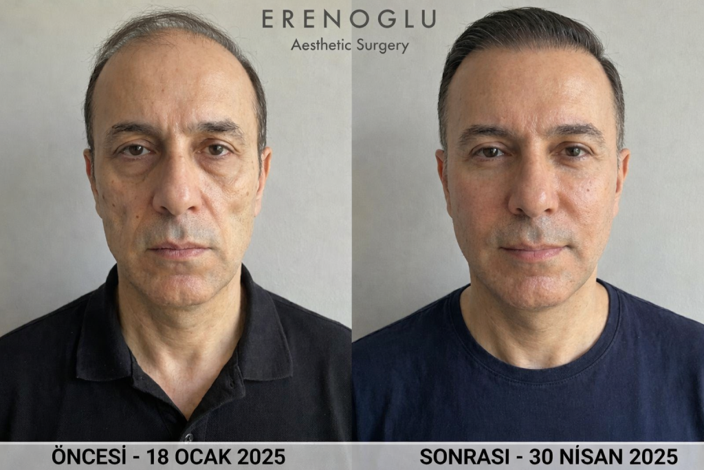 Orta Yüz Germe Öncesi Sonrası Değişimler