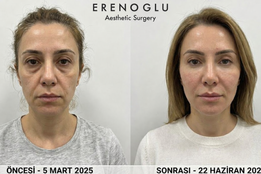 Orta Yüz Germe Öncesi Sonrası Değişimler