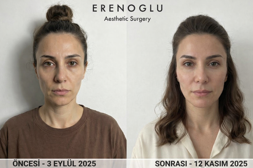 Orta Yüz Germe Öncesi Sonrası Değişimler